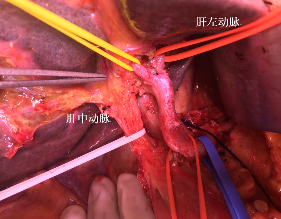 诊断:肝门部胆管癌bismuth iiib型术式:左半肝联合