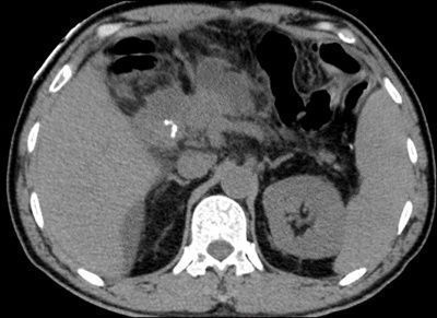 ct见十二指肠残端积液量进行性增多
