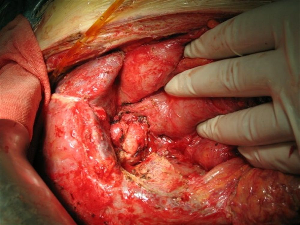 重建,自身胆囊瓣修补胆道前壁缺损,胆道支撑外引流术提纲:腹部刀刺伤