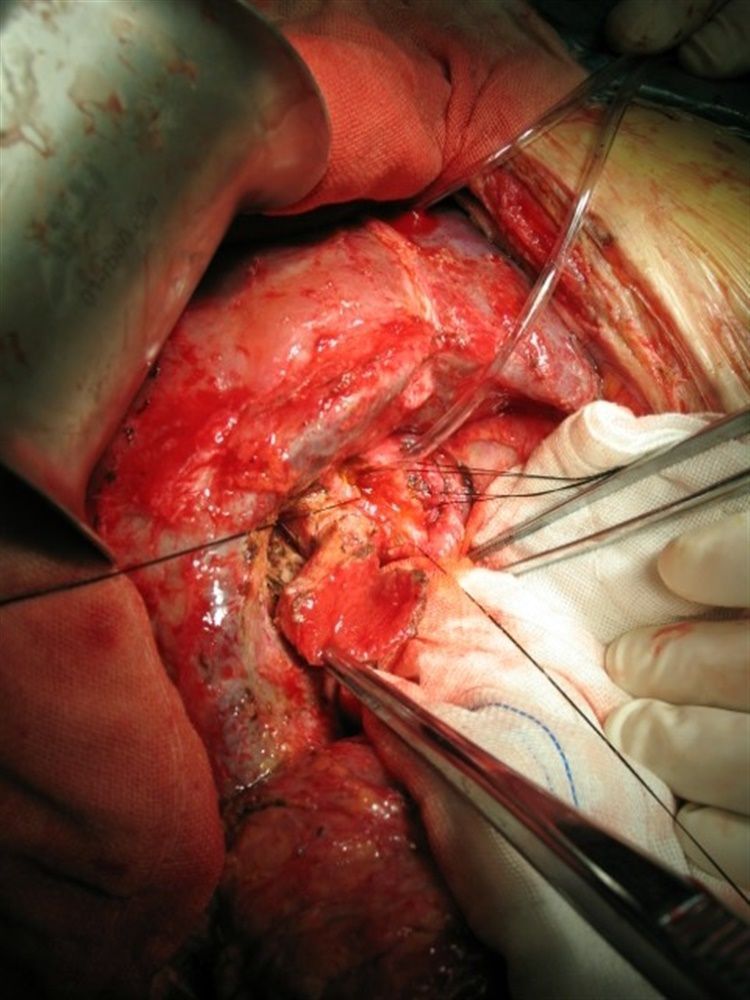 重建,自身胆囊瓣修补胆道前壁缺损,胆道支撑外引流术提纲:腹部刀刺伤