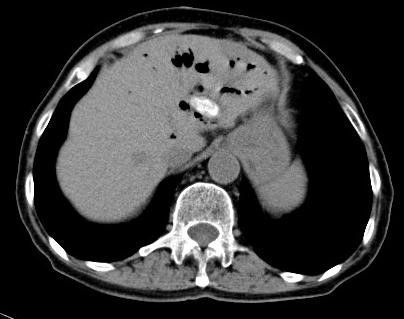 图1(ct):肝内胆管扩张,积气,大量高密度团块,以左肝管为甚.