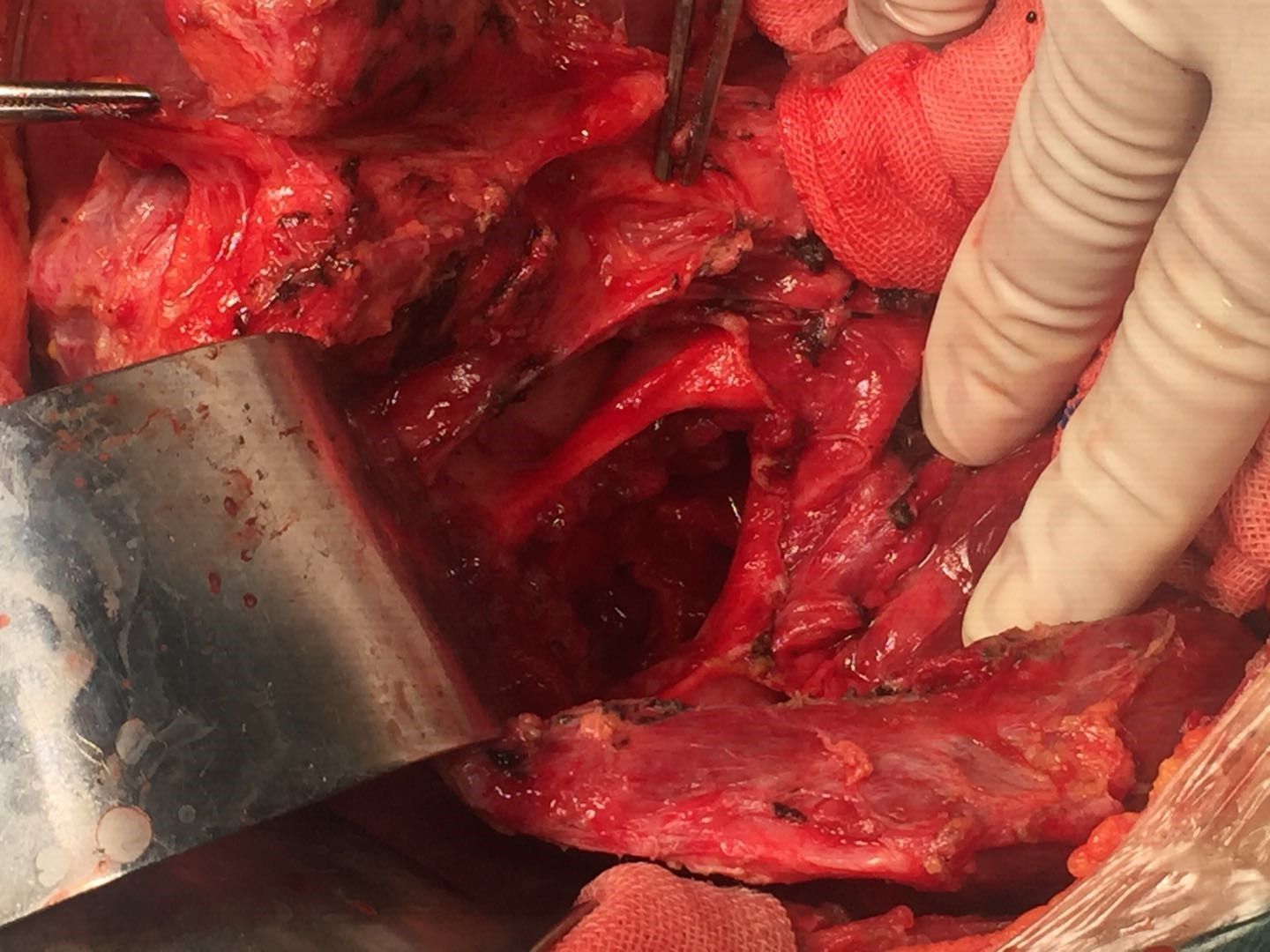 肝外胆管切除,胆管-空肠roux-en-y吻合术腹腔出血