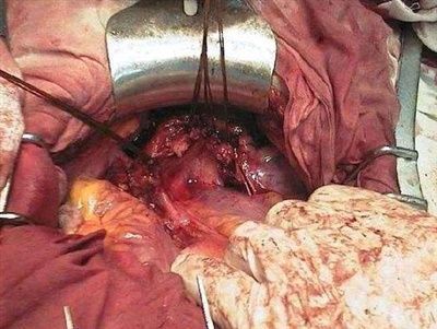 右半结肠癌根治术中损伤右侧输尿管