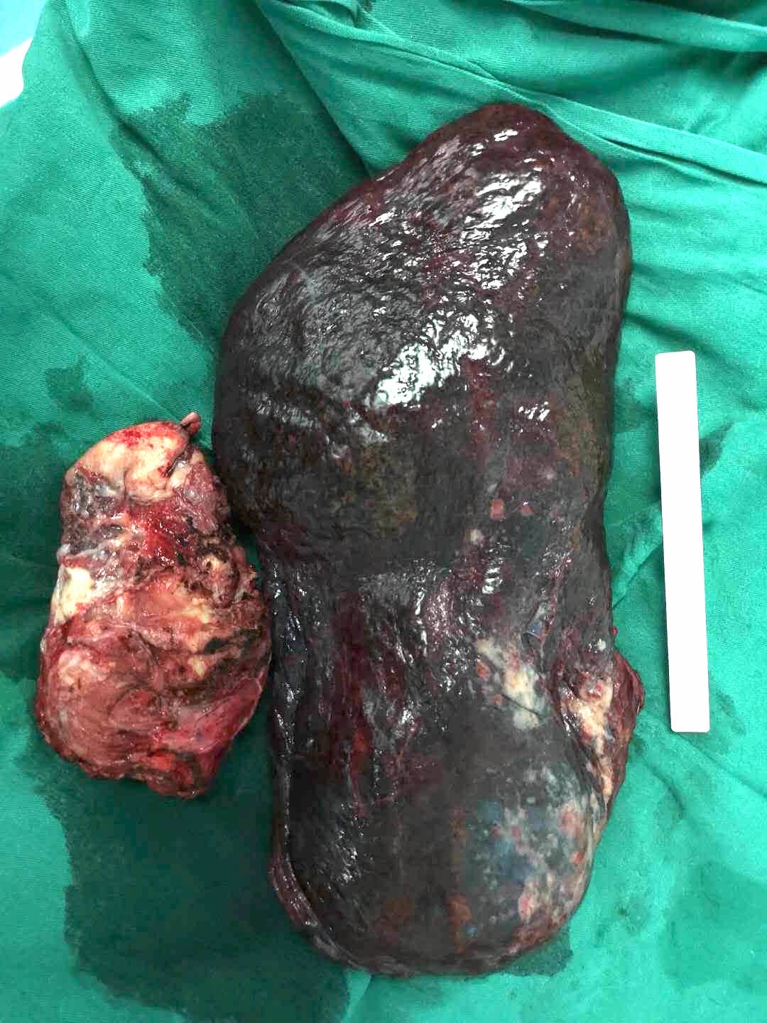 右肝巨大血管瘤术后突发心肌梗塞 - 病例 - peershare