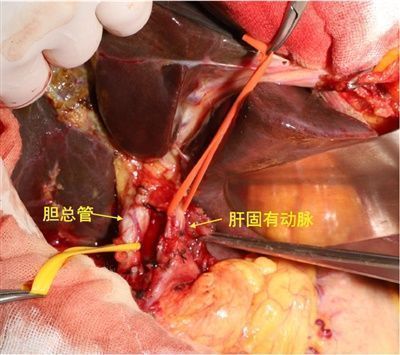 典型肝门部胆管癌行iv型肝门部胆管癌根治术一例 - 病例 - peershare